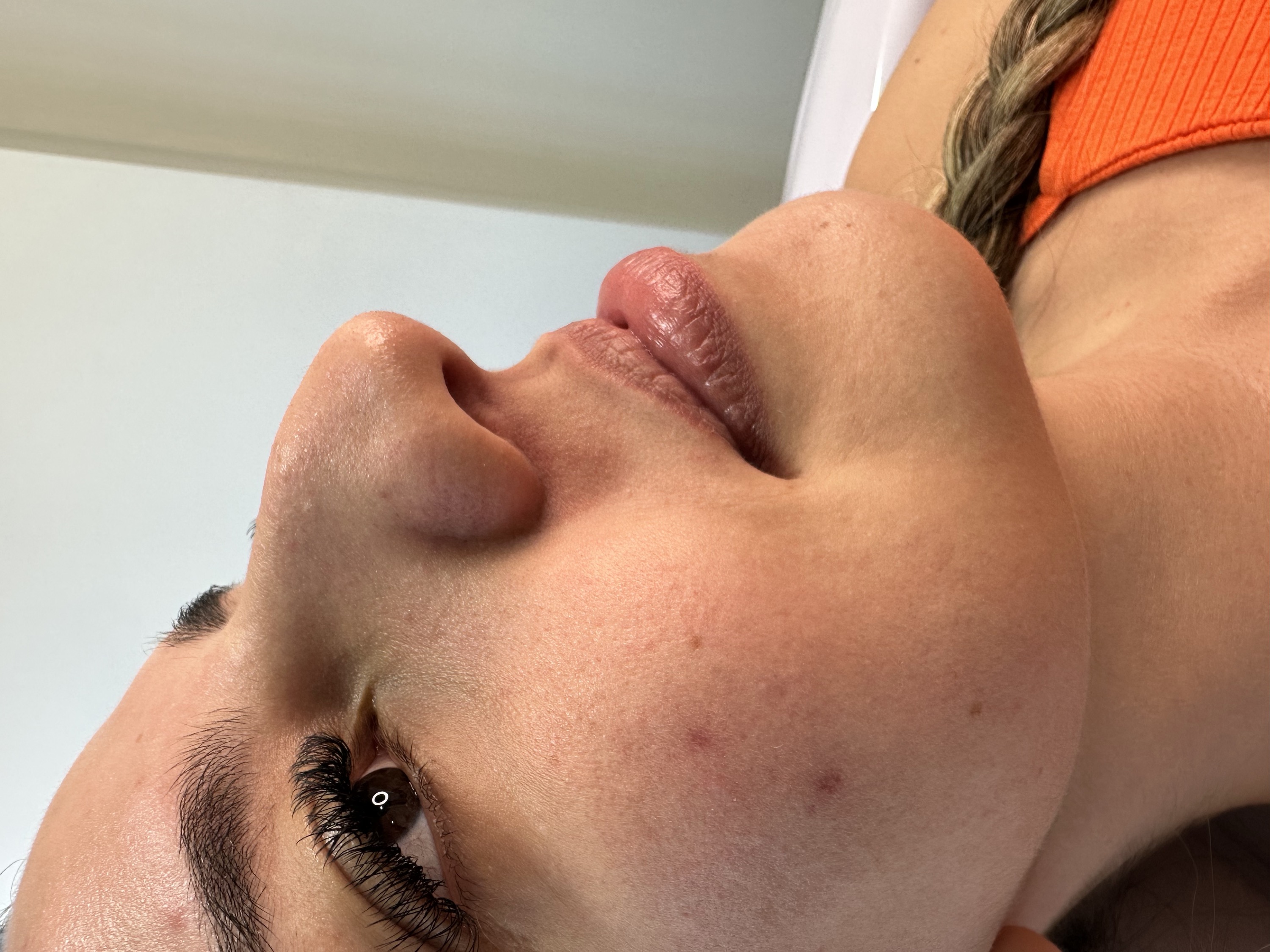 Antes do preenchimento labial, rosto em ângulo lateral