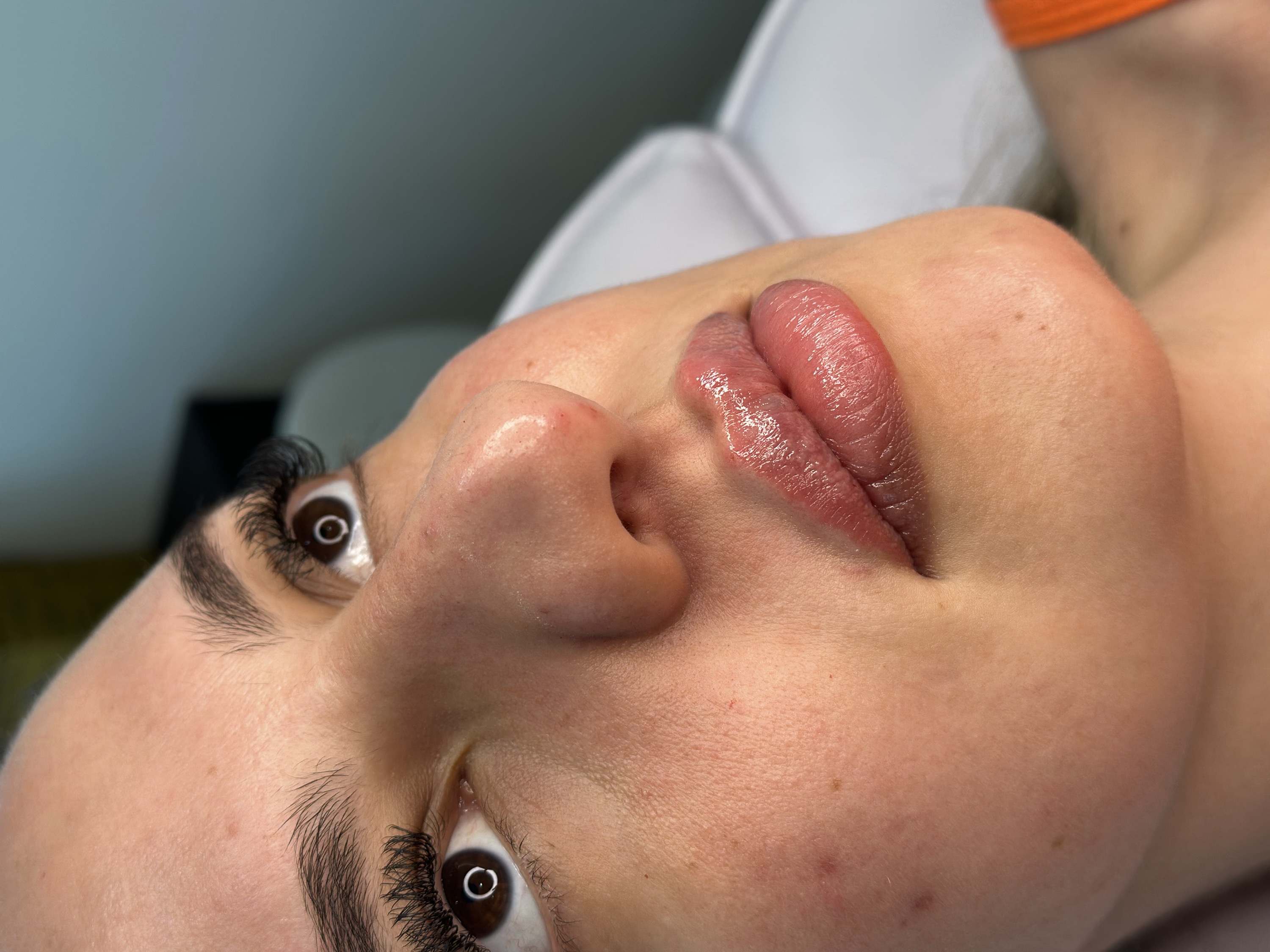Depois do preenchimento labial, rosto em ângulo lateral e lábios completos