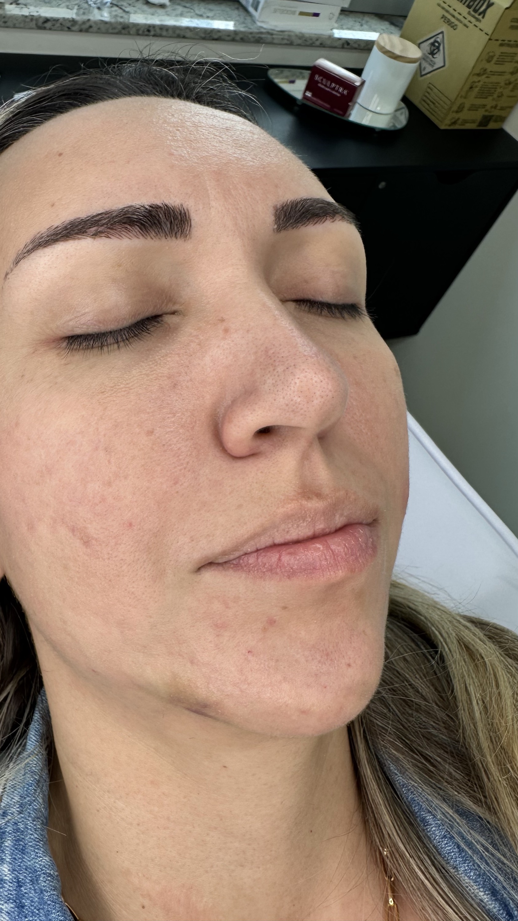 Antes do preenchimento labial, rosto em ângulo lateral