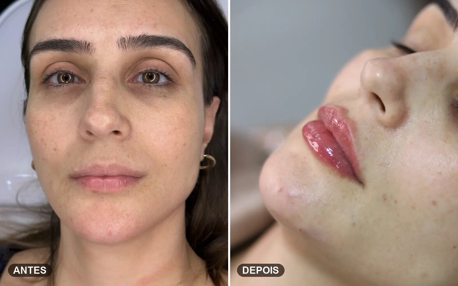 Antes e depois de preenchimento labial natural com volume e contorno harmônicos