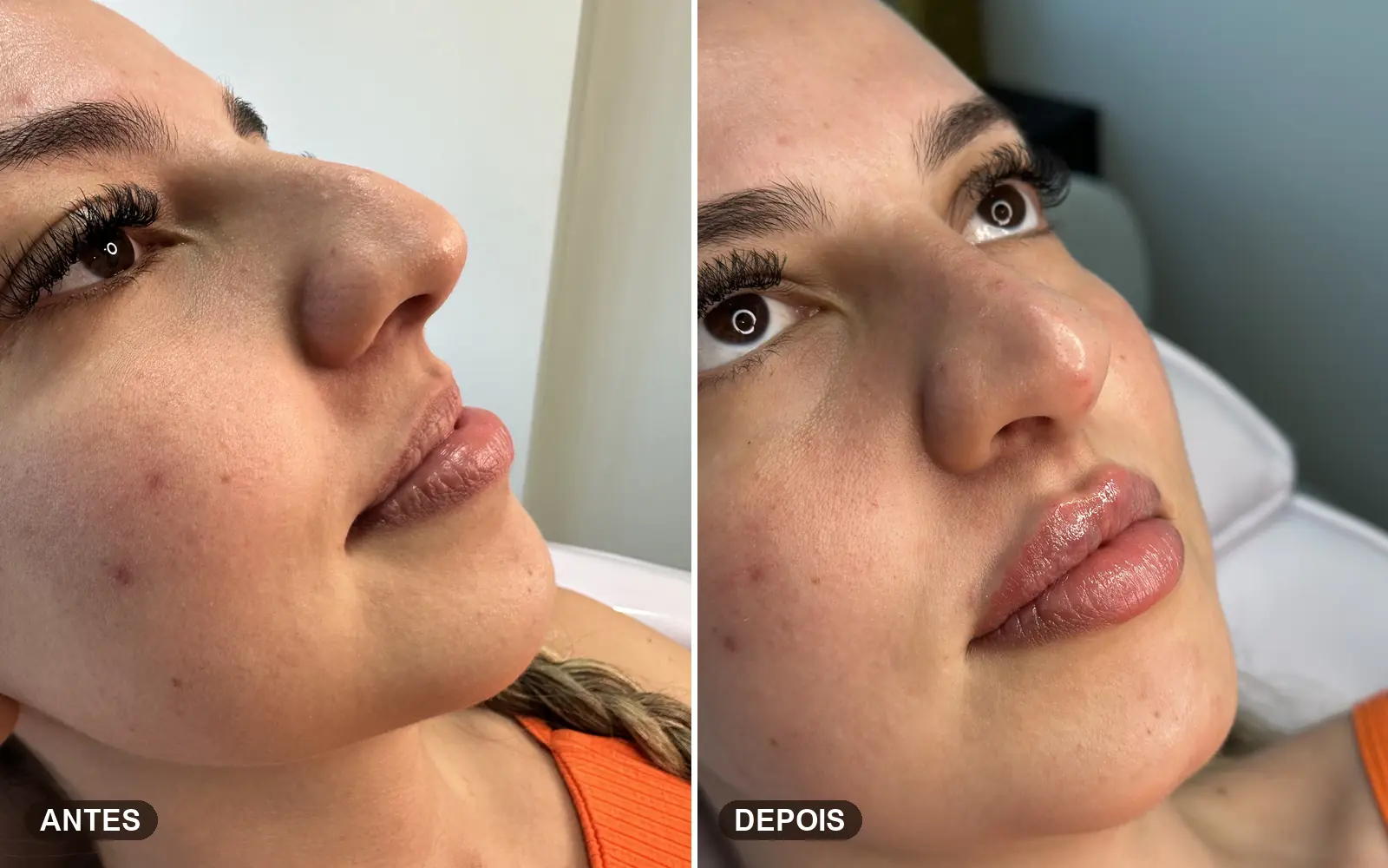 Resultado de preenchimento labial com ácido hialurônico em Londrina