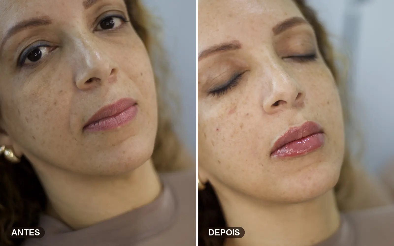 Antes e depois de lábios preenchidos com aspecto natural