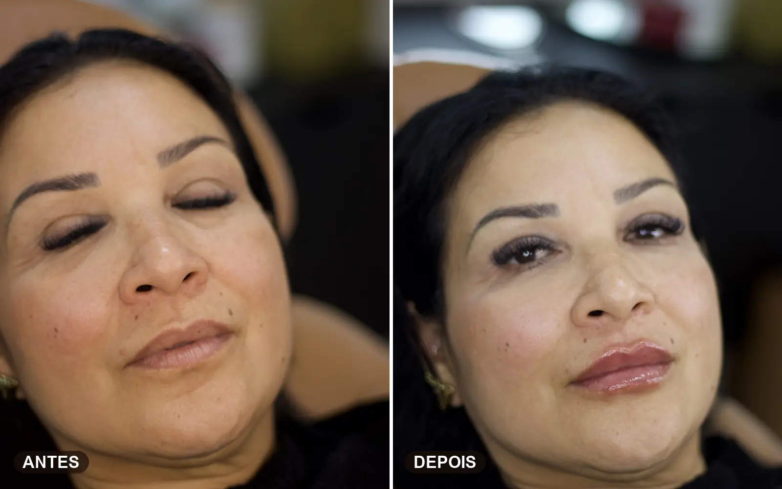 Preenchimento labial natural realçando o contorno dos lábios