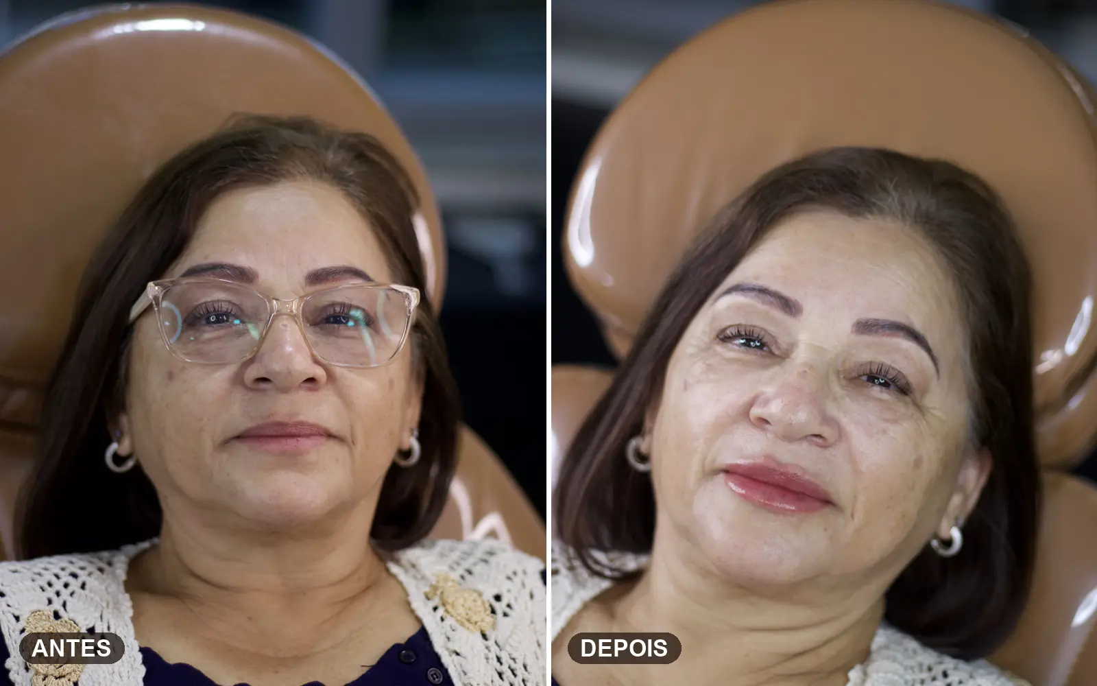 Lábios harmônicos após preenchimento labial com a Bruna Binotto