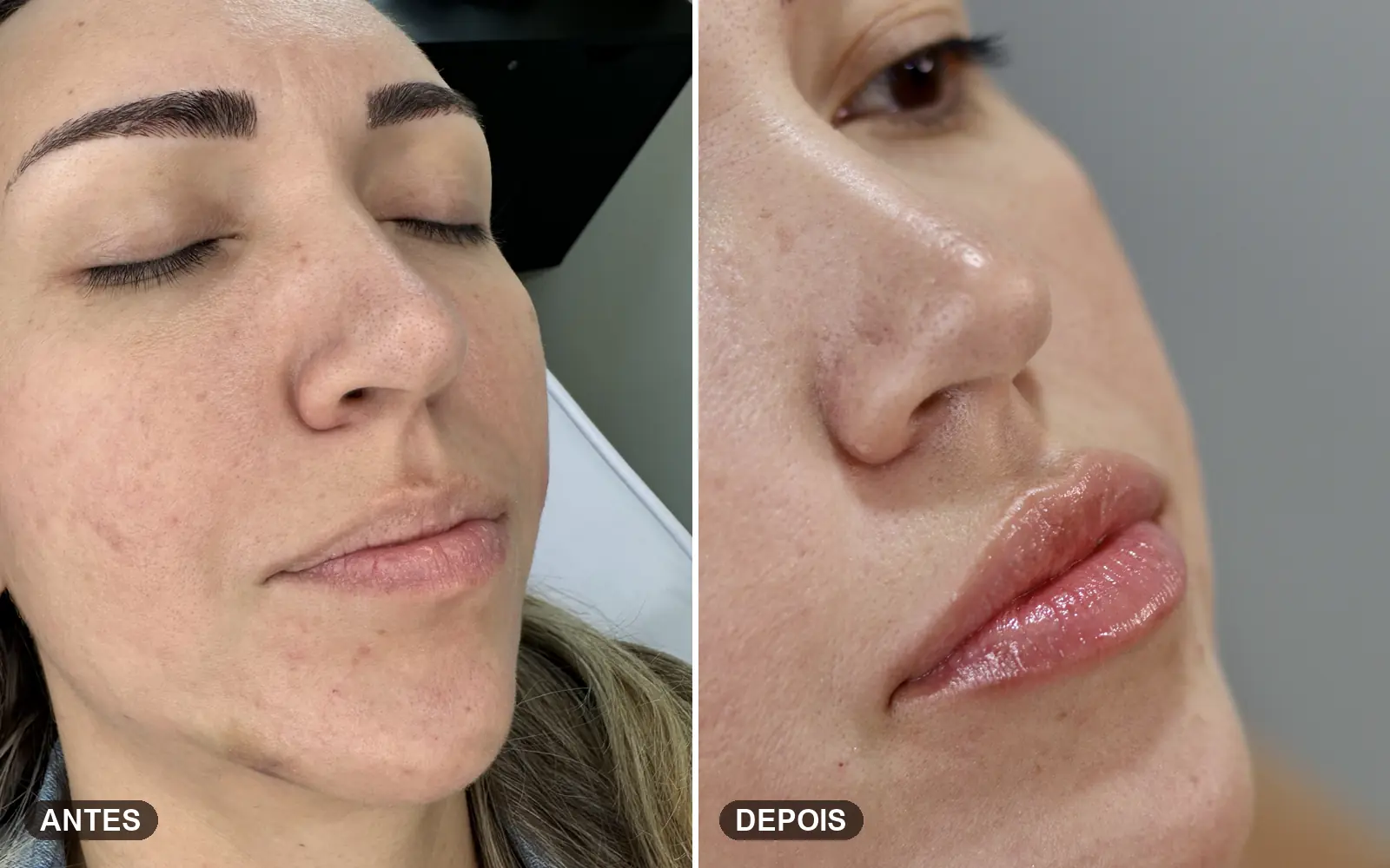 Antes e depois de preenchimento labial com acabamento natural e brilho saudável