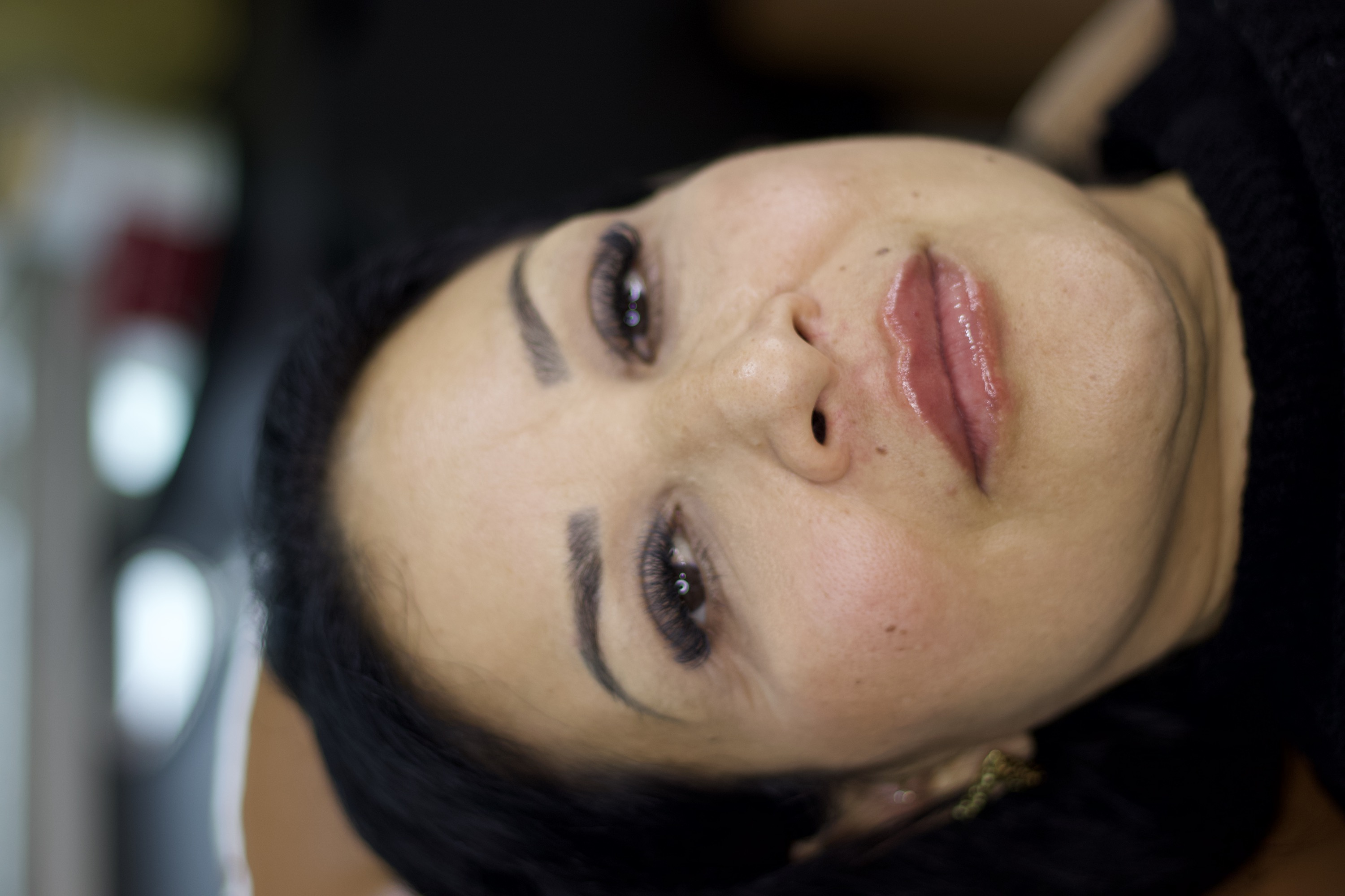 Depois do preenchimento labial, rosto frontal reclinado e lábios completos