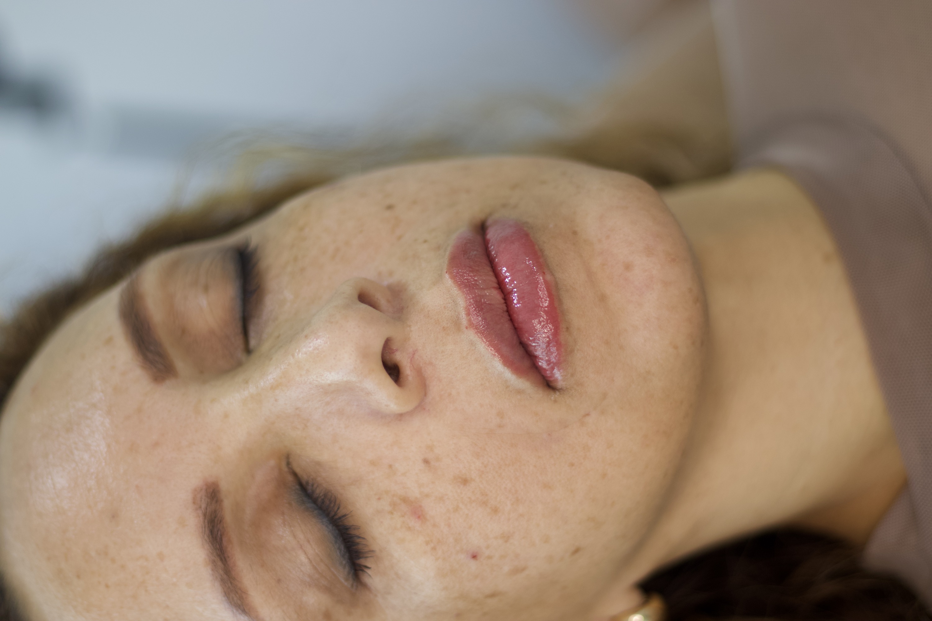 Depois do preenchimento labial, rosto em ângulo três quartos e lábios completos
